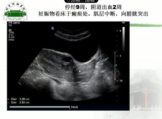 異位妊娠名詞解釋(異位妊娠的名詞解釋是)-添財網