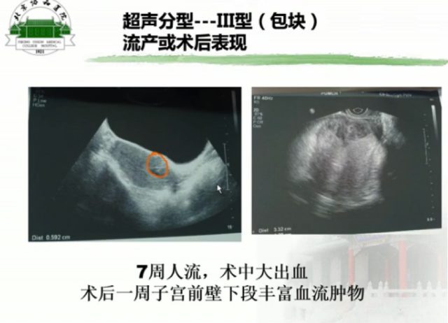 異位妊娠名詞解釋(異位妊娠的名詞解釋是)-添財網