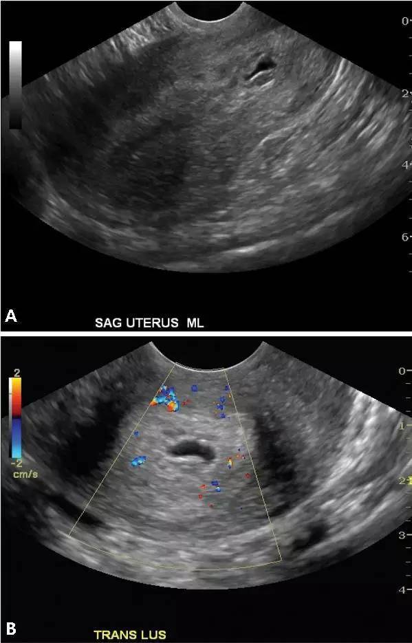 異位妊娠名詞解釋(妊娠異位的臨床表現)-添財網