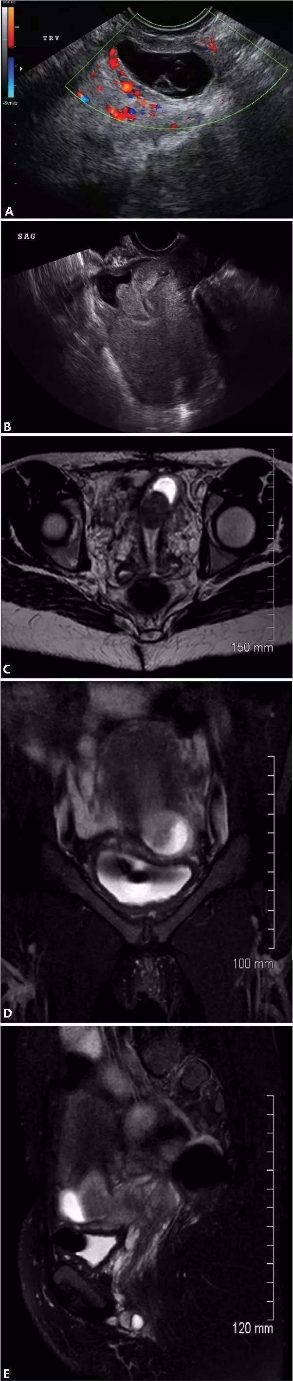 異位妊娠名詞解釋(妊娠異位的臨床表現)-添財網