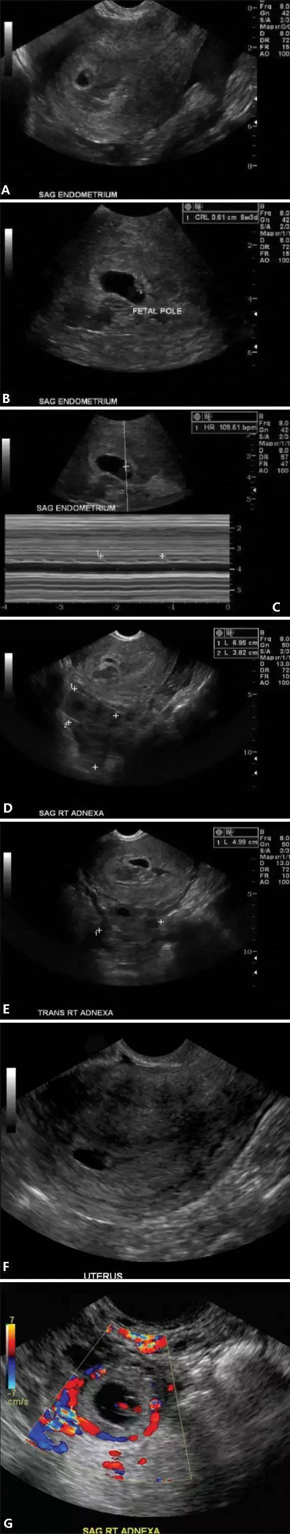 異位妊娠名詞解釋(妊娠異位的臨床表現)-添財網