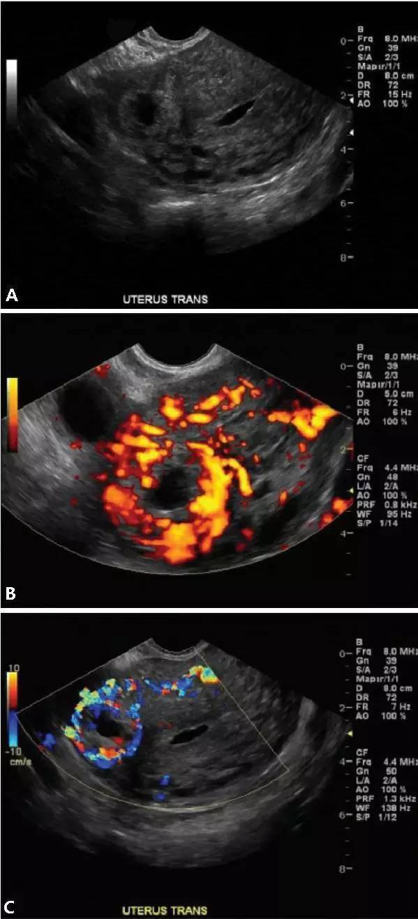 異位妊娠名詞解釋(妊娠異位的臨床表現)-添財網