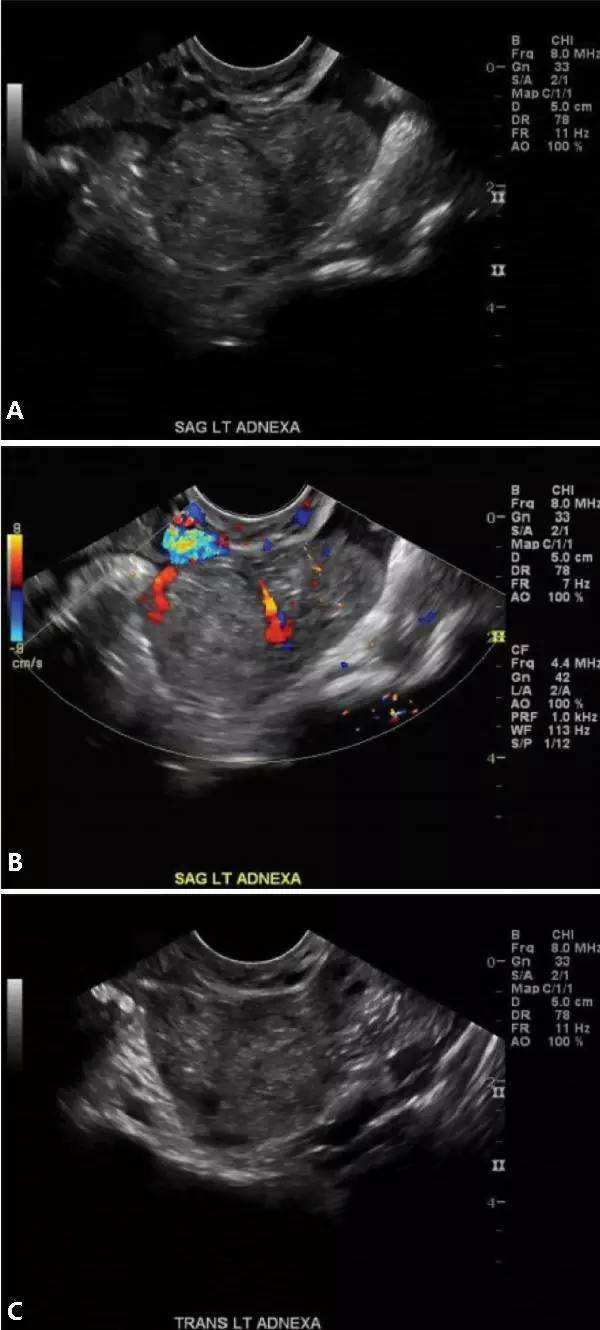 異位妊娠名詞解釋(妊娠異位的臨床表現)-添財網