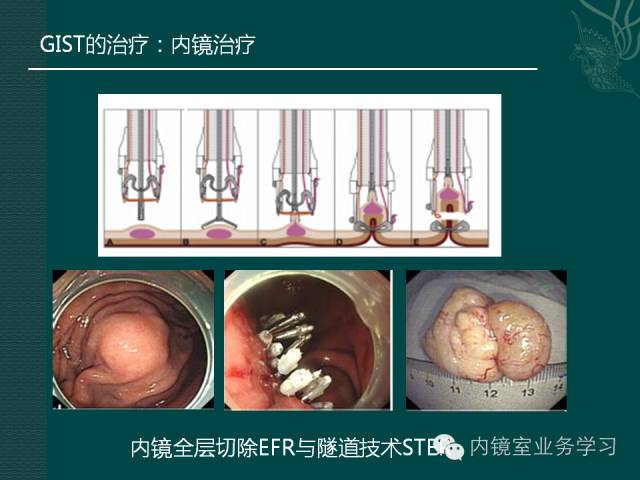 什么是間質(zhì)瘤(間質(zhì)瘤形狀)-添財(cái)網(wǎng)