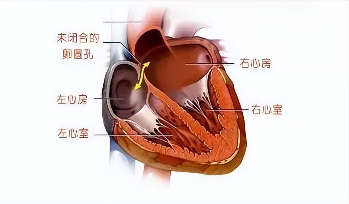 卵圓孔未閉屬于大病嗎(卵圓孔未閉屬于重大疾病嗎)-添財(cái)網(wǎng)