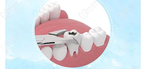 洗牙醫保報銷嗎(醫保報銷洗牙費用嗎)-添財網