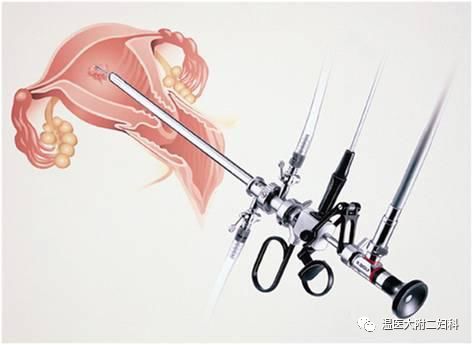 宮腔鏡手術可以報銷嗎(宮腔鏡手術可以走醫保報銷嗎)-添財網