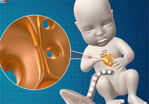 卵圓孔未閉屬于大病嗎(卵圓孔閉合)-添財網