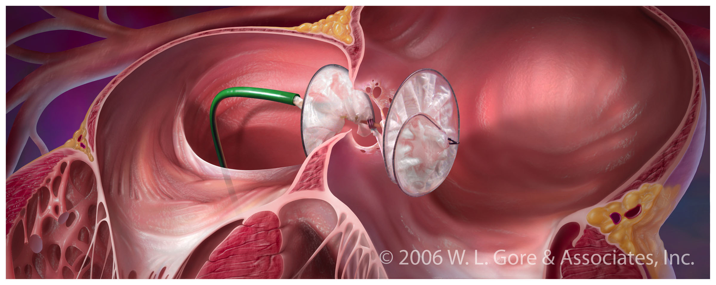 卵圓孔未閉屬于大病嗎(卵圓孔閉合)-添財網