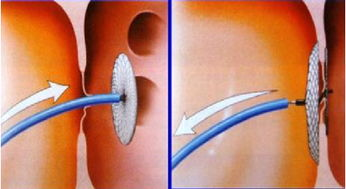 卵圓孔未閉屬于大病嗎(卵圓孔閉合)-添財網