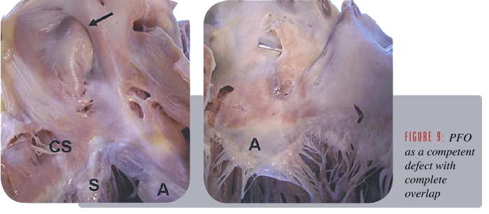 卵圓孔未閉屬于大病嗎(卵圓孔閉合)-添財網